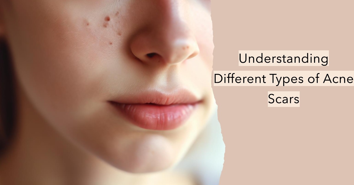 understanding-different-types-of-acne-scars